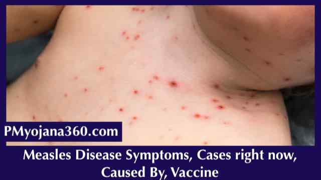 Measles Disease