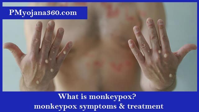 What is monkeypox monkeypox symptoms & treatment